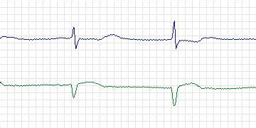 mit-bih ecg compression test database|Beecardia .